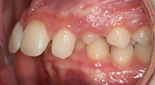 upper front teeth Protrusion